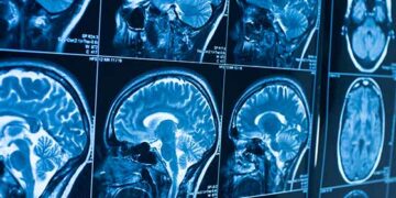 Beyin xərçənginin müalicəsi üçün yeni müalicə üsulu kəşf edildi!