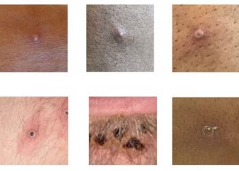 Meymunçiçəyi Simptomlar, Yoluxma və Qarşısının Alınması