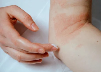 Sədəf xəstəliyini daha da qabardan qidalar açıqlanıb