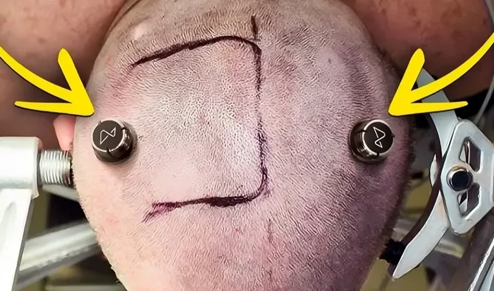 Neuralink-in kütləvi istehsalı 2026-da başlayır